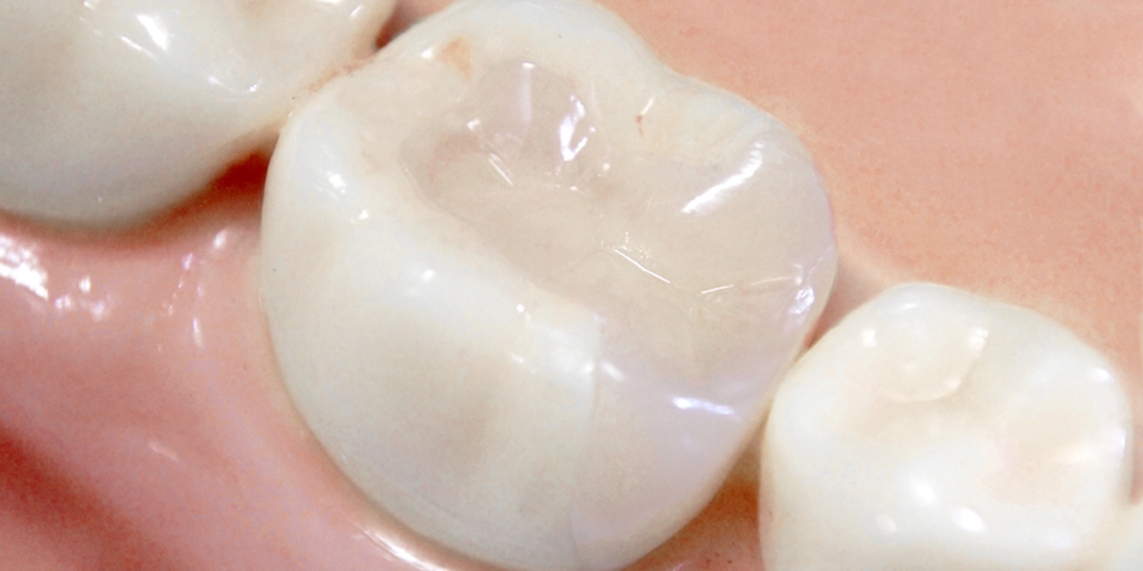 セラミックインレー