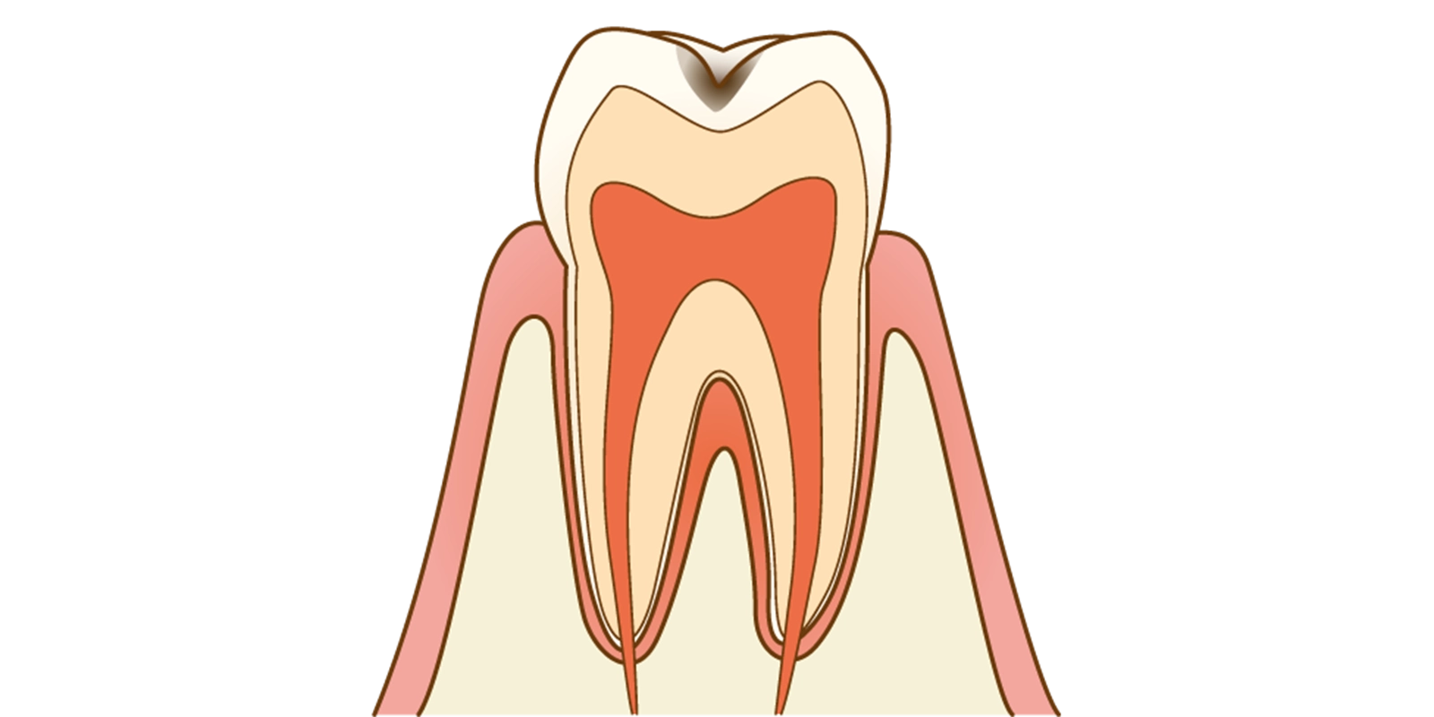 エナメル質の虫歯(C1):表層の破壊