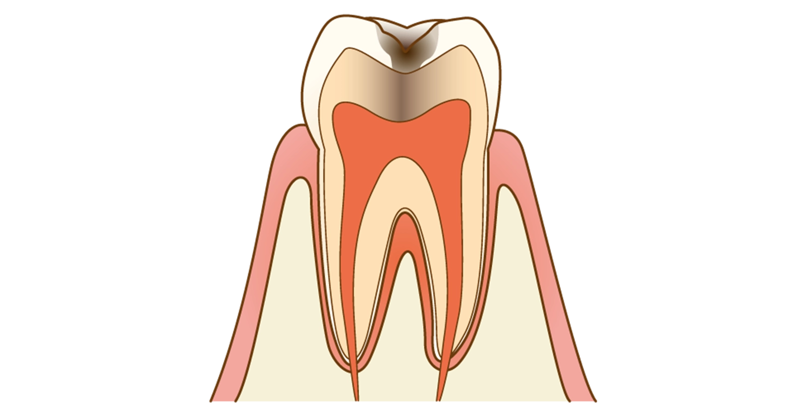 象牙質の虫歯(C2):知覚過敏の出現