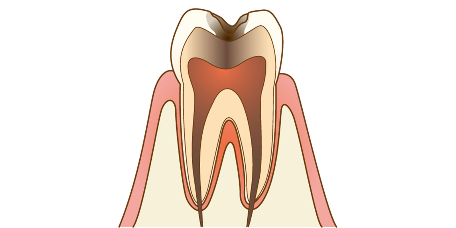 歯髄の虫歯(C3):持続的な疼痛