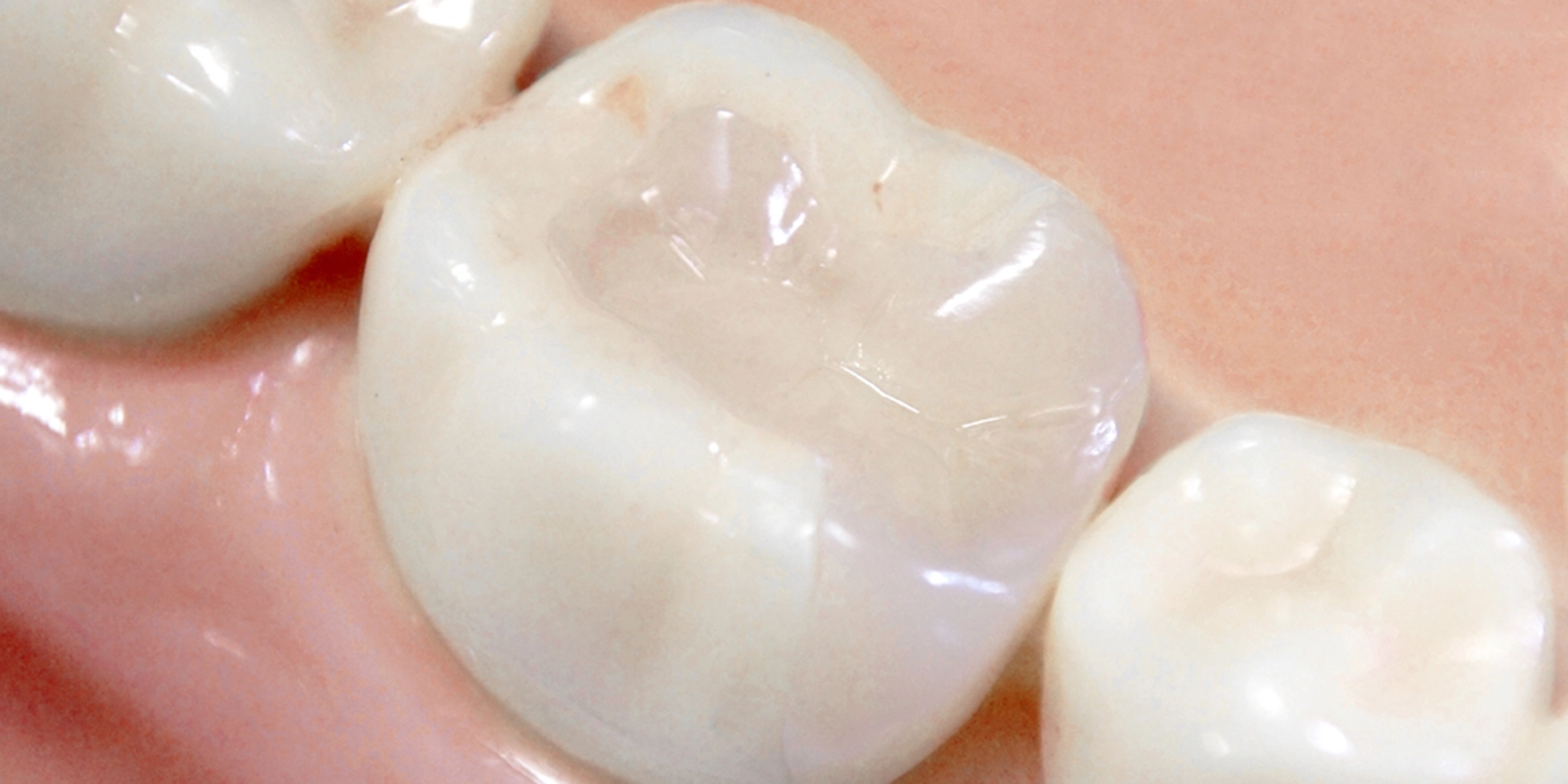 C1〜C2段階での充填治療