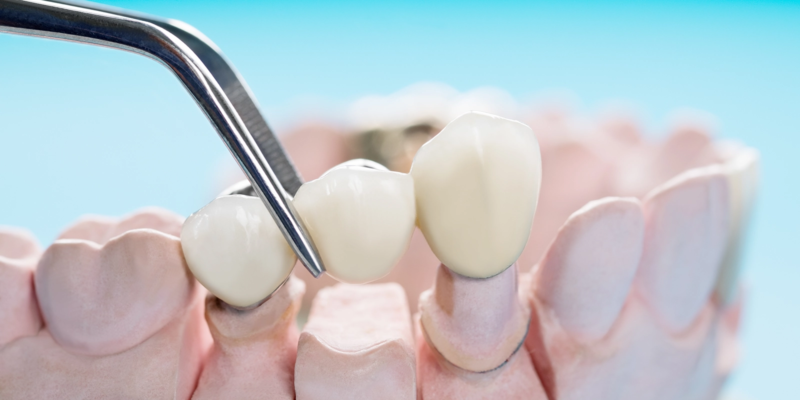 ブリッジとの比較