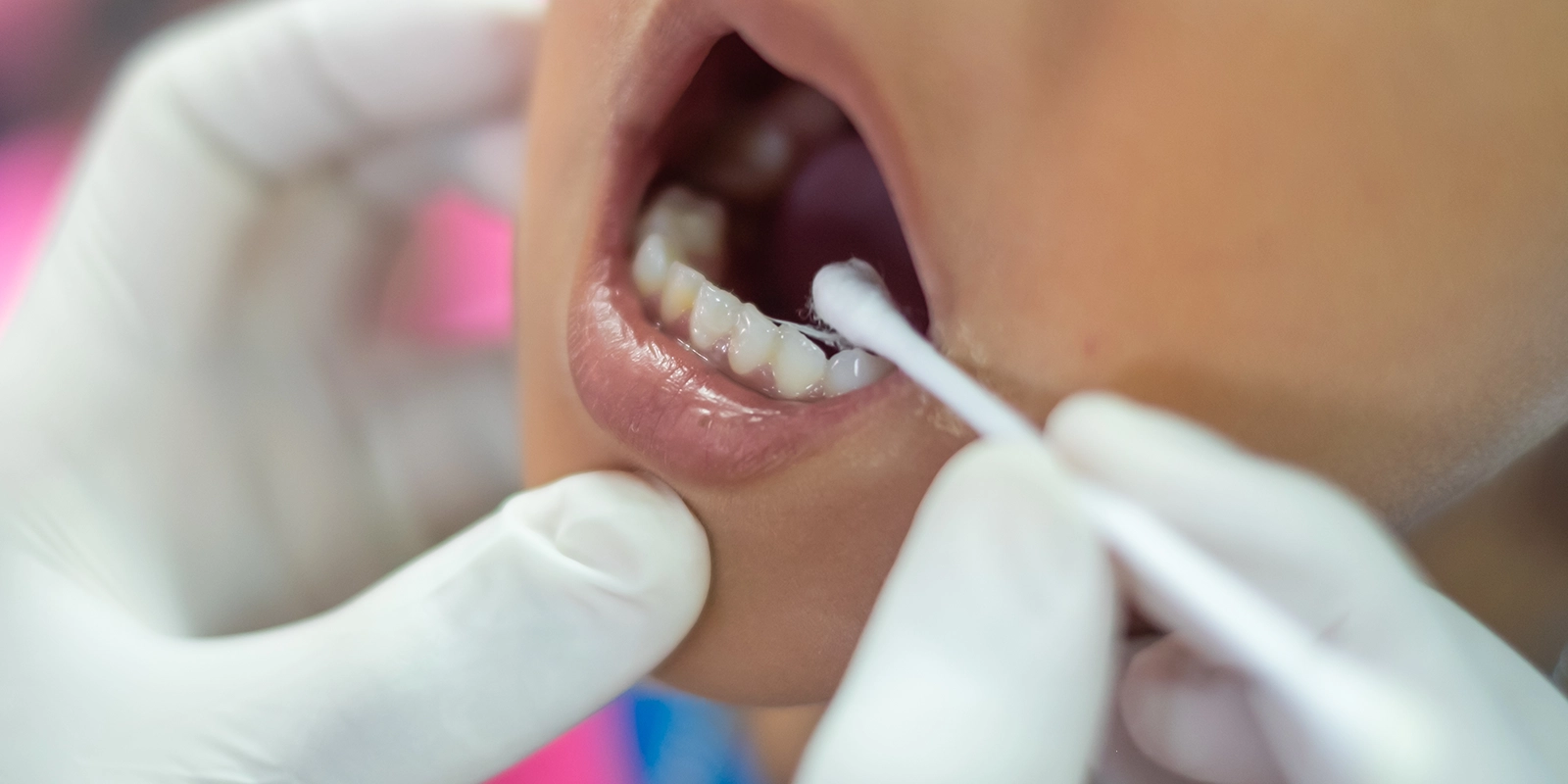 フッ素塗布による歯質強化