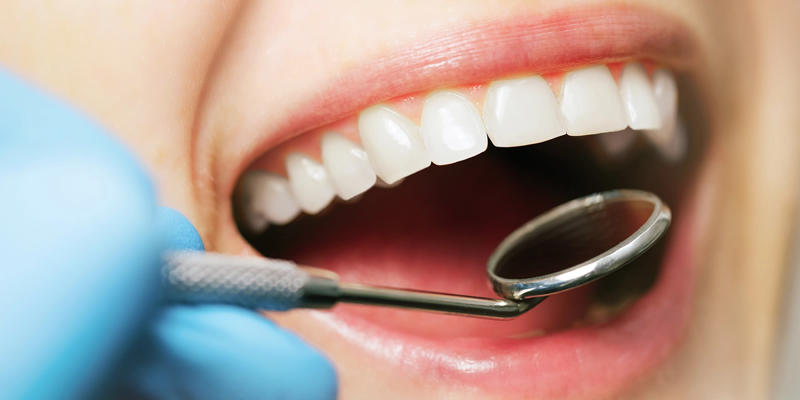 予防歯科のメリット