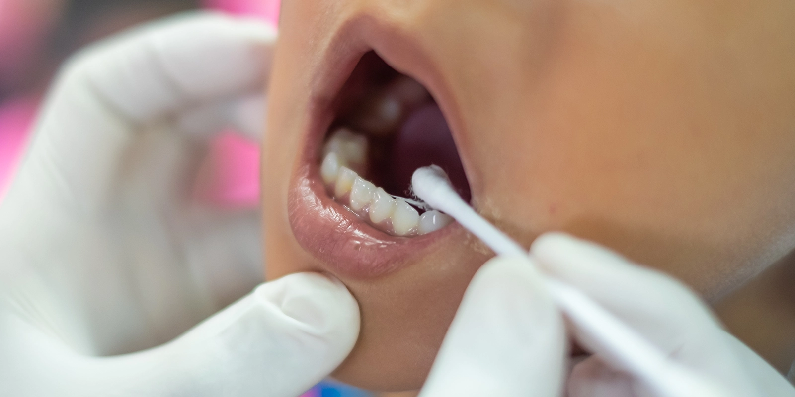 フッ素塗布による歯質強化