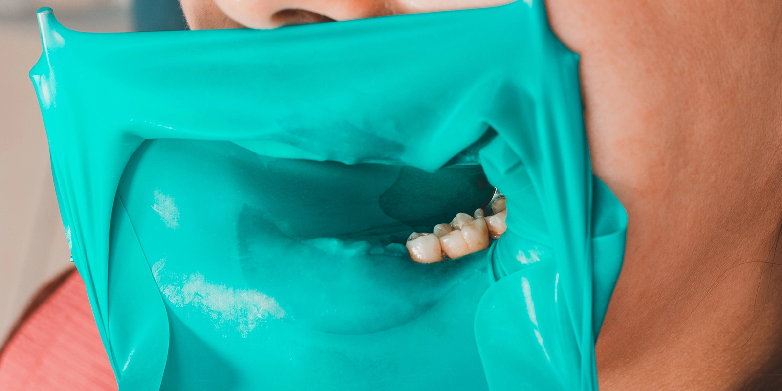 ラバーダムで清潔な環境を保つ