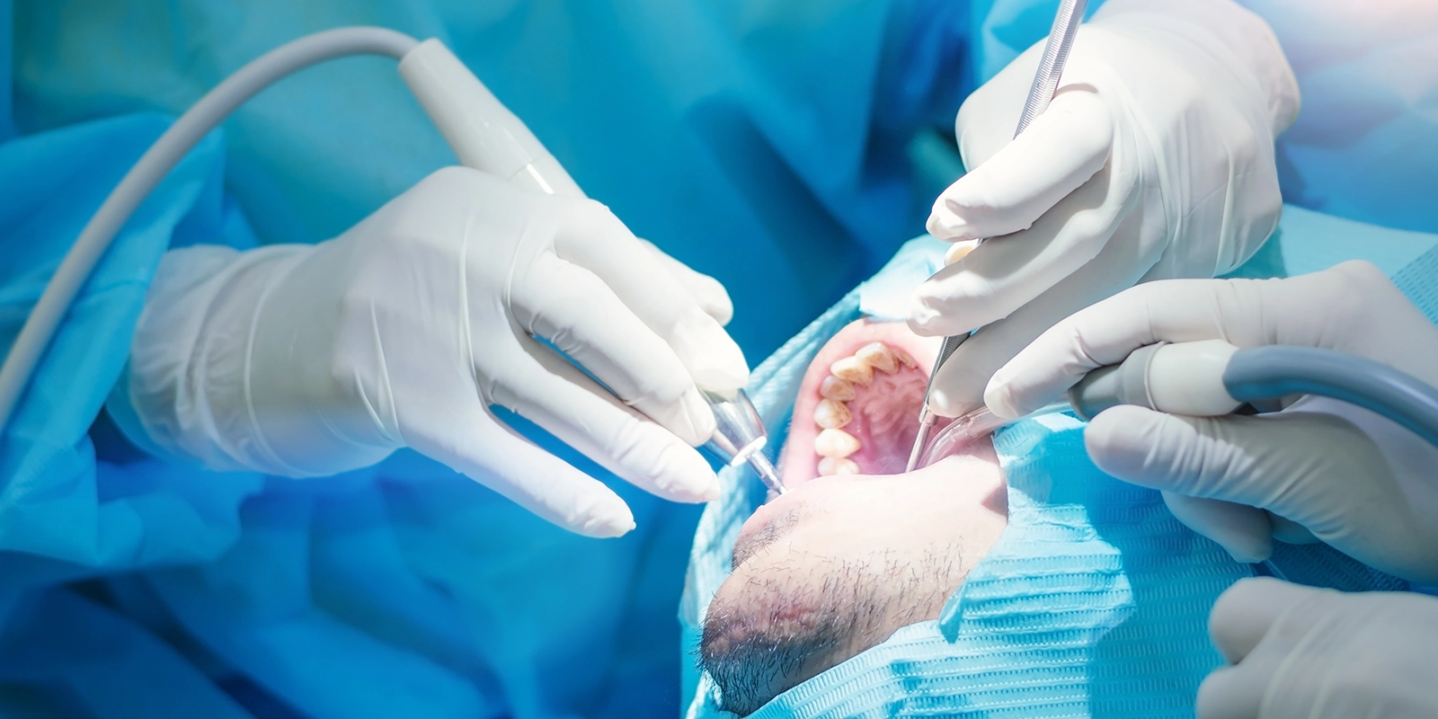 親知らず抜歯の手順